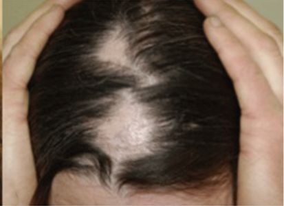 Hair Care Tips for Alopecia
