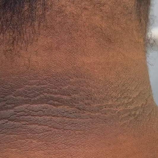 Could Your Hyperpigmentation be Due to Insulin Resistance?