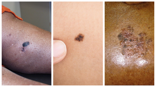 Black People and Skin Cancer: How Living in Northern Countries with Little Sun Can Increase Your Risk