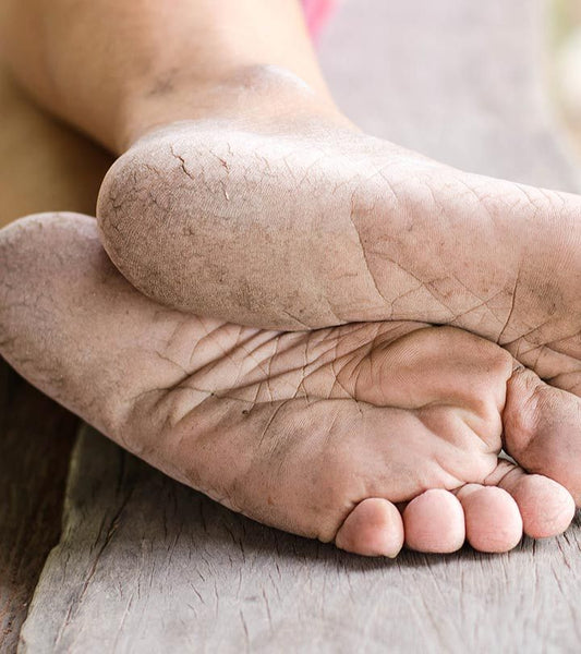 Cracked Heels, Chapped Lips, Flakey Skin: Vitamin Deficiencies